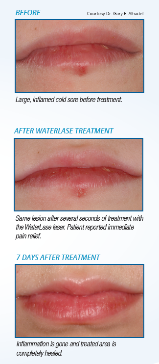 WaterLase Dentistry for Canker and Cold Sores