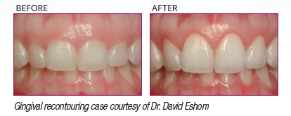WaterLase Dentistry to improve the appearance of your smile