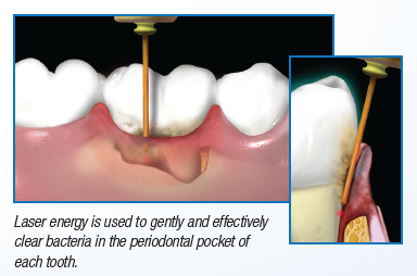 WaterLase being used to clean bacteria from a periodontal pocket